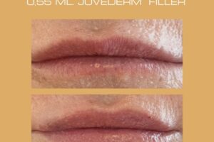 ACHIEVEMENT CLINIC 0,55 ML. JUVEDERM FILLER